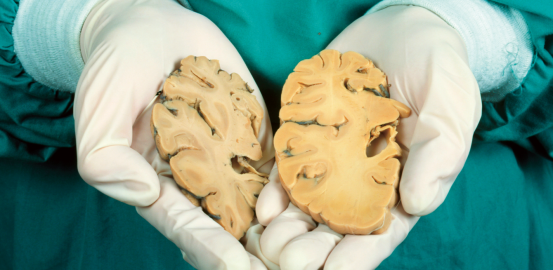 Alzheimer: le casse-tête des chercheurs